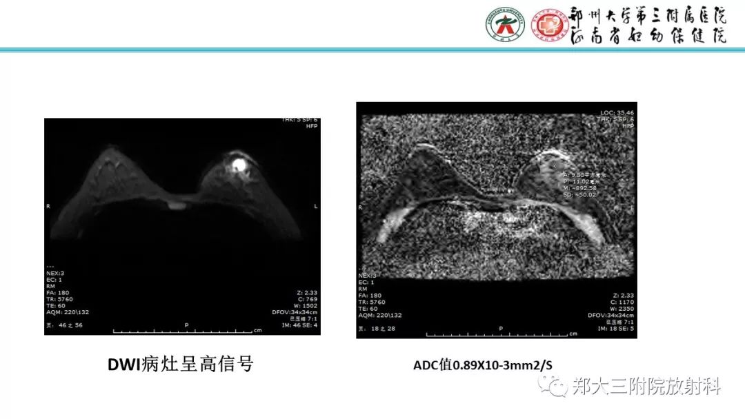 影像PPT - 【PPT】乳腺MRI诊断原则及常见病例-53