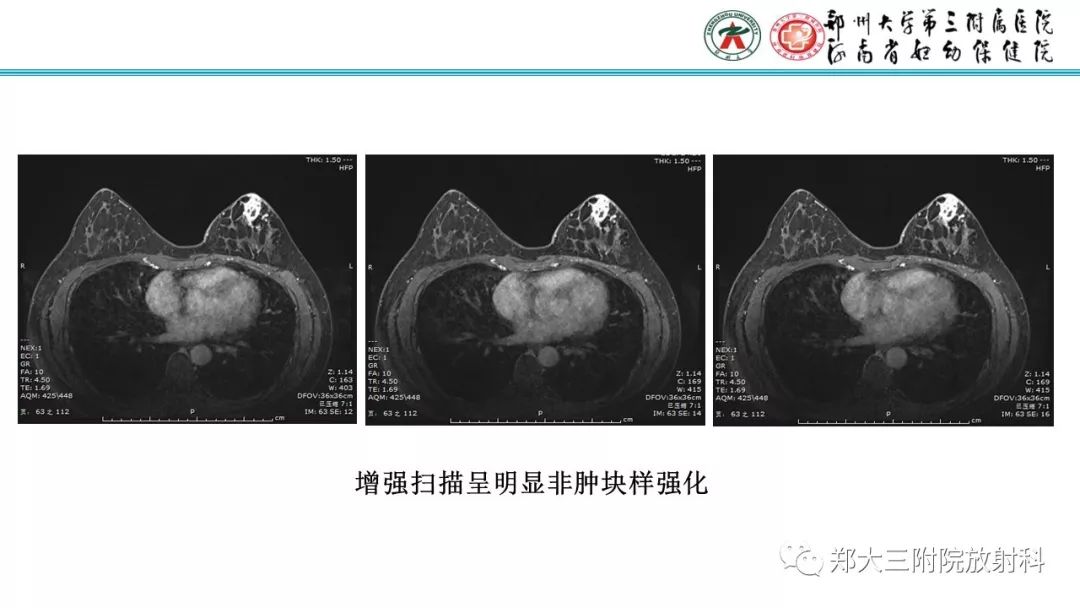 影像PPT - 【PPT】乳腺MRI诊断原则及常见病例-54