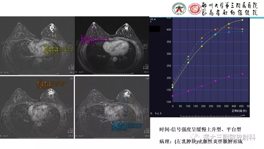 影像PPT - 【PPT】乳腺MRI诊断原则及常见病例-55