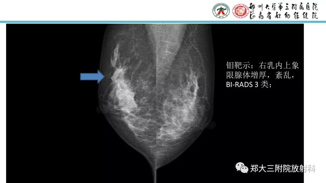 影像PPT - 【PPT】乳腺MRI诊断原则及常见病例-59