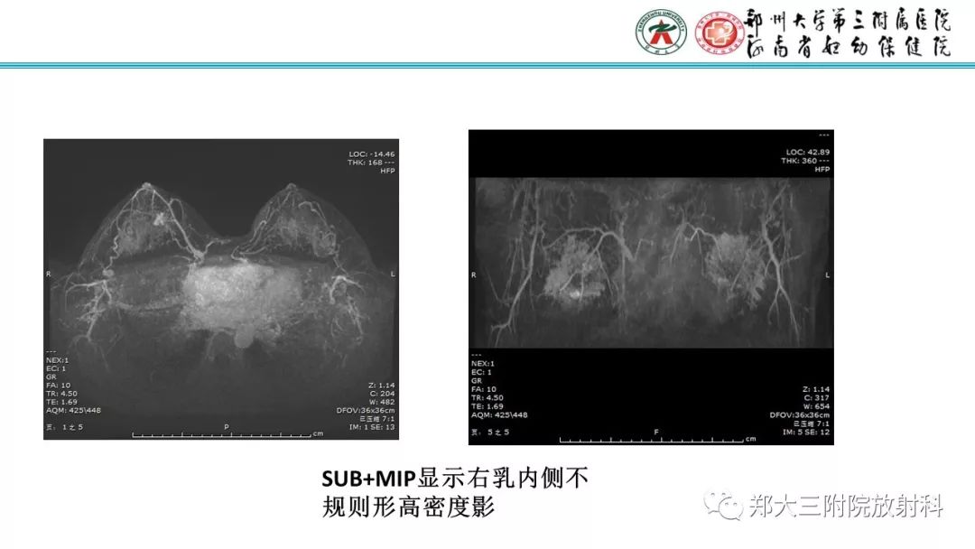 影像PPT - 【PPT】乳腺MRI诊断原则及常见病例-61