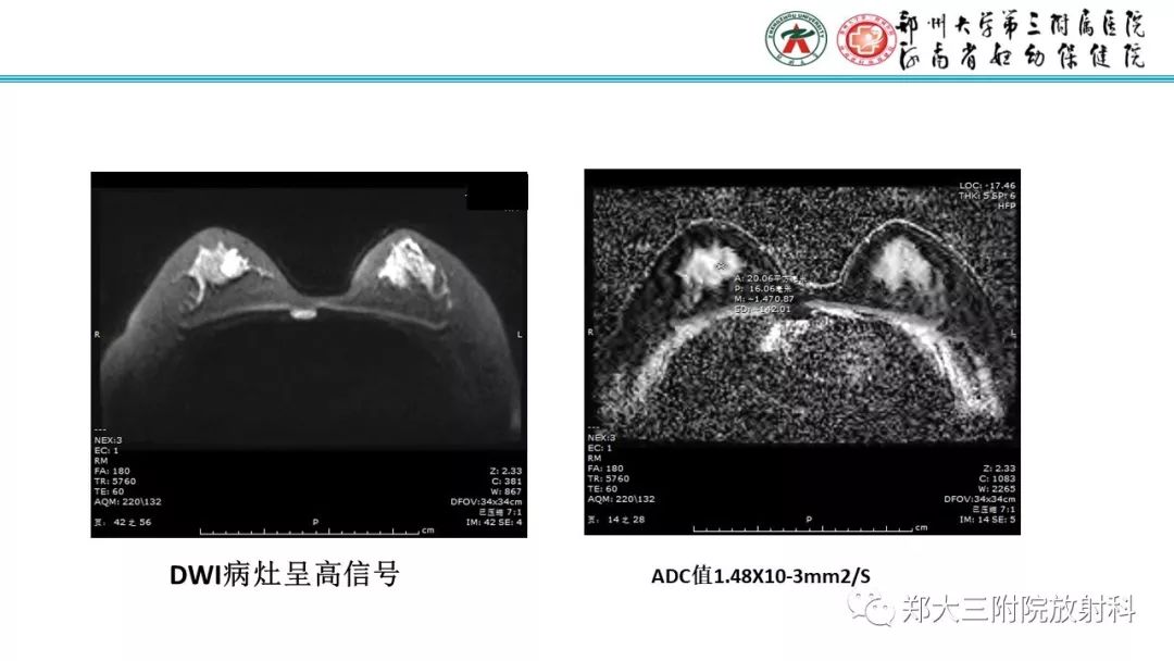 影像PPT - 【PPT】乳腺MRI诊断原则及常见病例-62