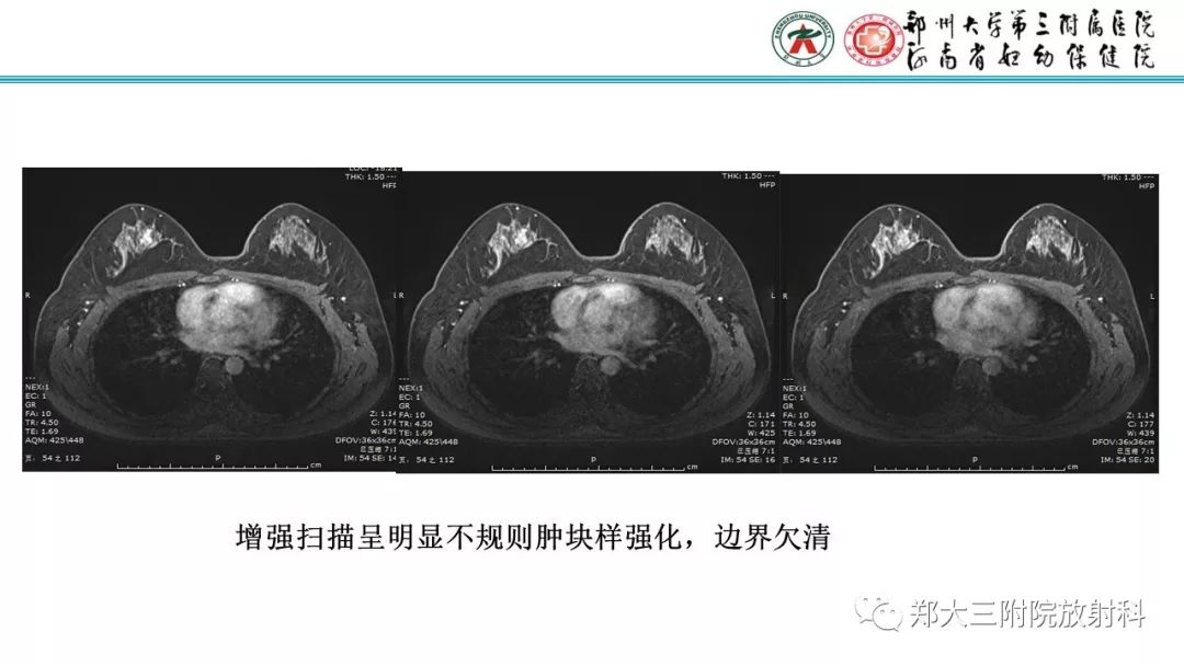 影像PPT - 【PPT】乳腺MRI诊断原则及常见病例-63
