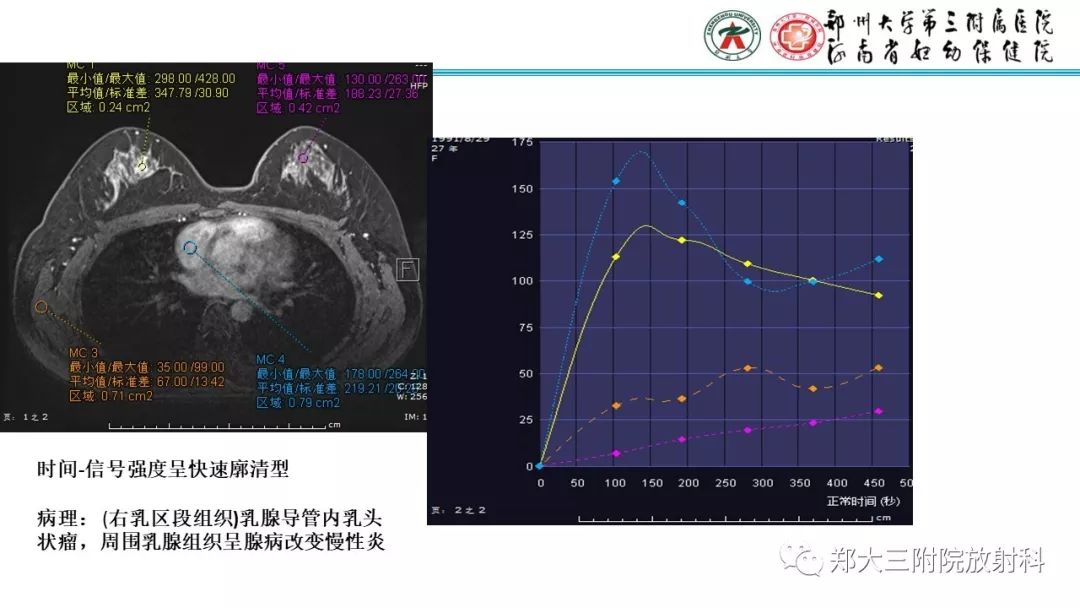 影像PPT - 【PPT】乳腺MRI诊断原则及常见病例-64