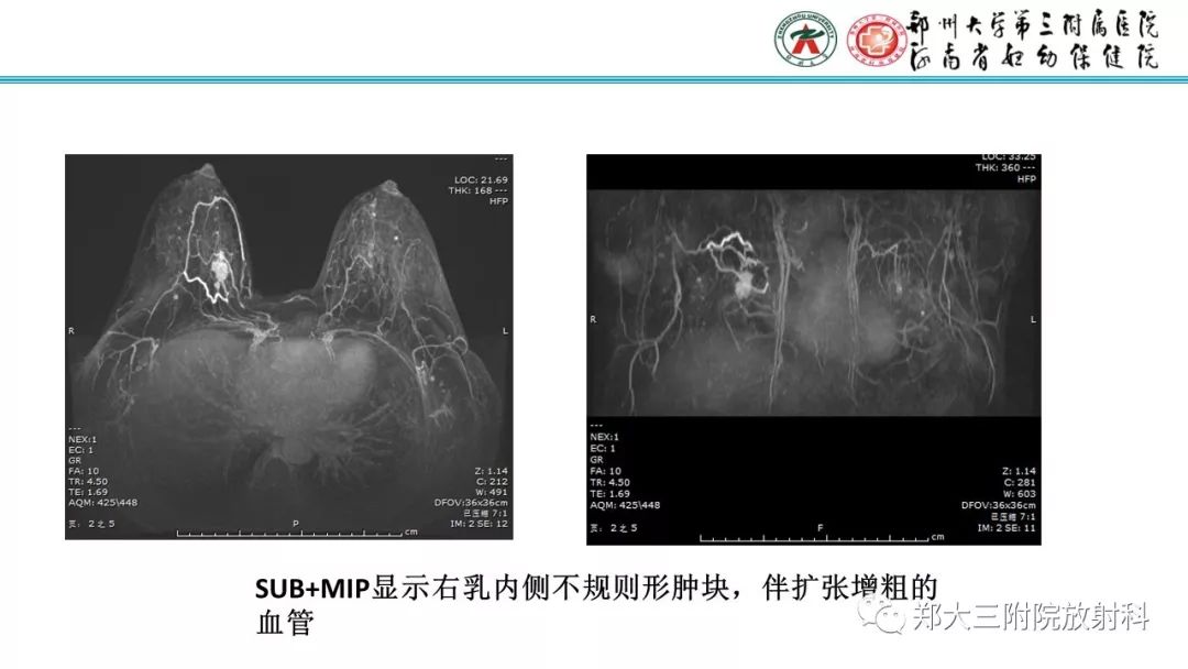 影像PPT - 【PPT】乳腺MRI诊断原则及常见病例-69