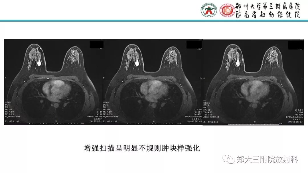 影像PPT - 【PPT】乳腺MRI诊断原则及常见病例-70