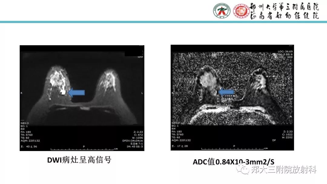 影像PPT - 【PPT】乳腺MRI诊断原则及常见病例-71