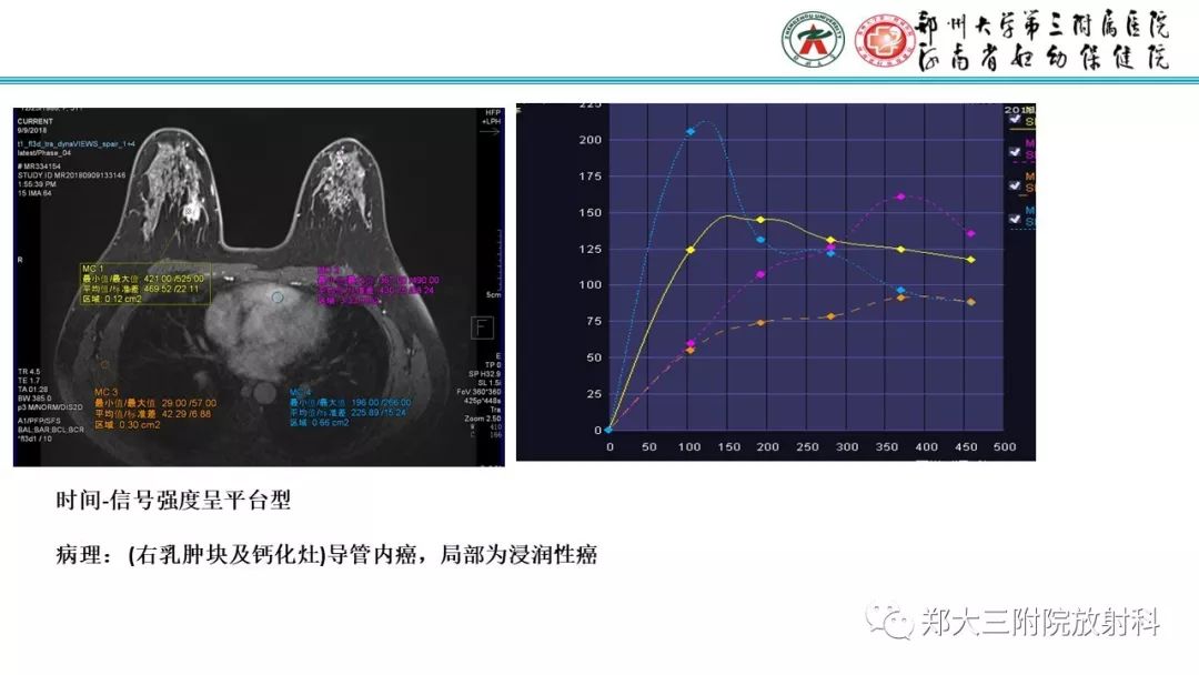 影像PPT - 【PPT】乳腺MRI诊断原则及常见病例-72