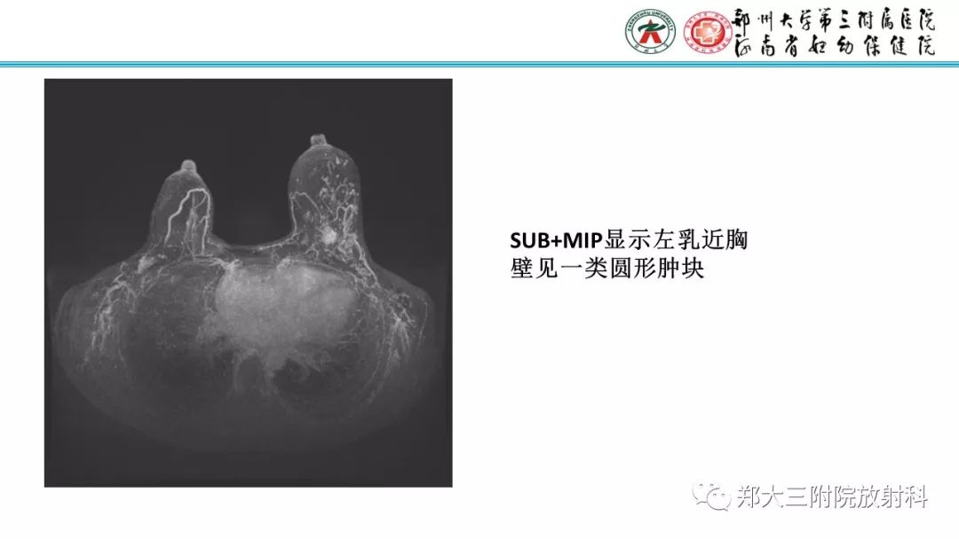 影像PPT - 【PPT】乳腺MRI诊断原则及常见病例-76