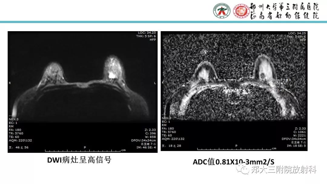 影像PPT - 【PPT】乳腺MRI诊断原则及常见病例-77