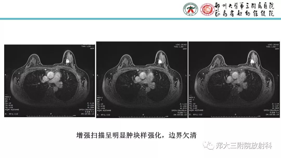 影像PPT - 【PPT】乳腺MRI诊断原则及常见病例-78