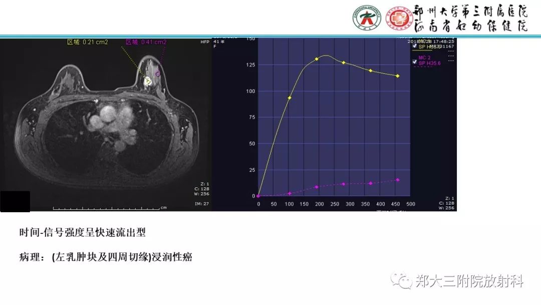 影像PPT - 【PPT】乳腺MRI诊断原则及常见病例-79