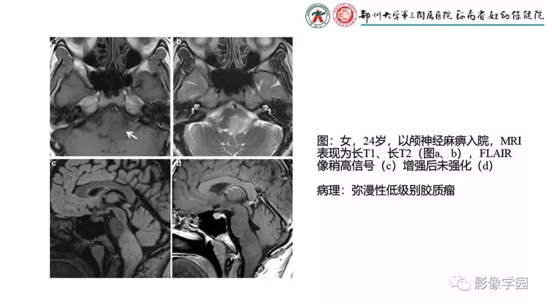 影像PPT - 【PPT】脑干病变的影像学表现-6