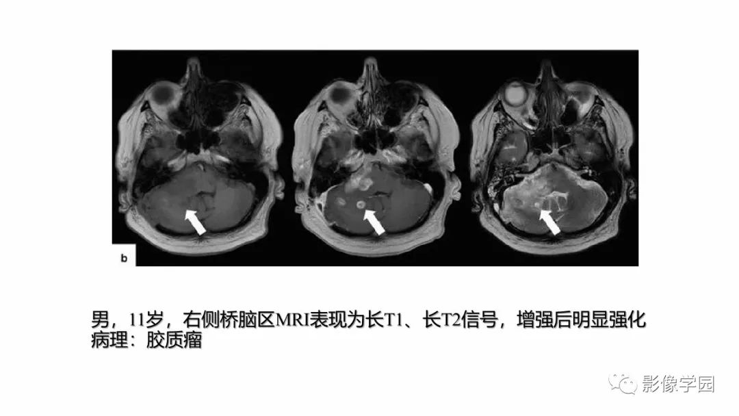 影像PPT - 【PPT】脑干病变的影像学表现-7
