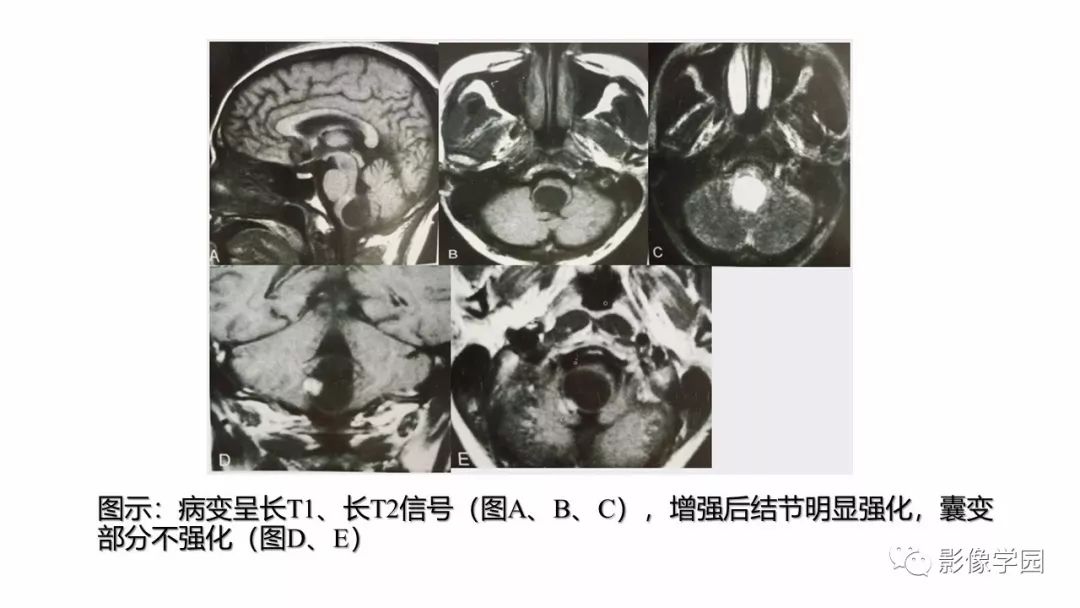 影像PPT - 【PPT】脑干病变的影像学表现-10