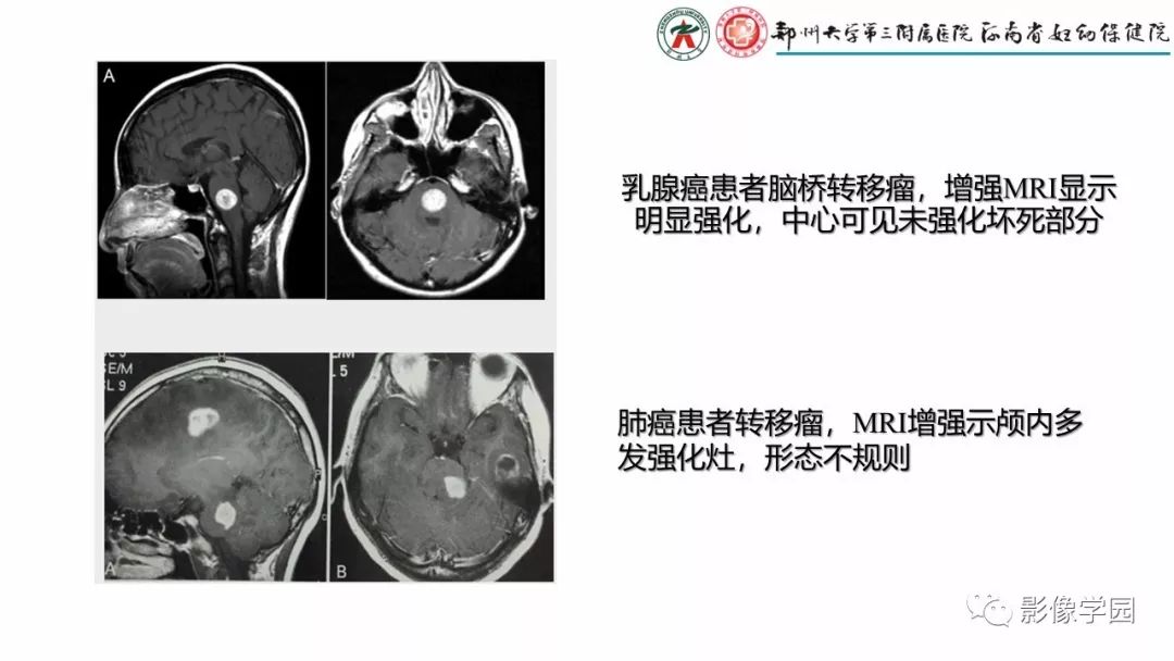 影像PPT - 【PPT】脑干病变的影像学表现-12