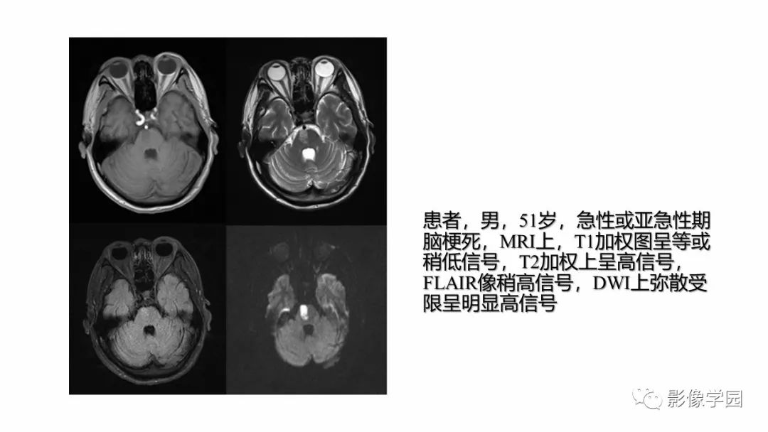 影像PPT - 【PPT】脑干病变的影像学表现-14
