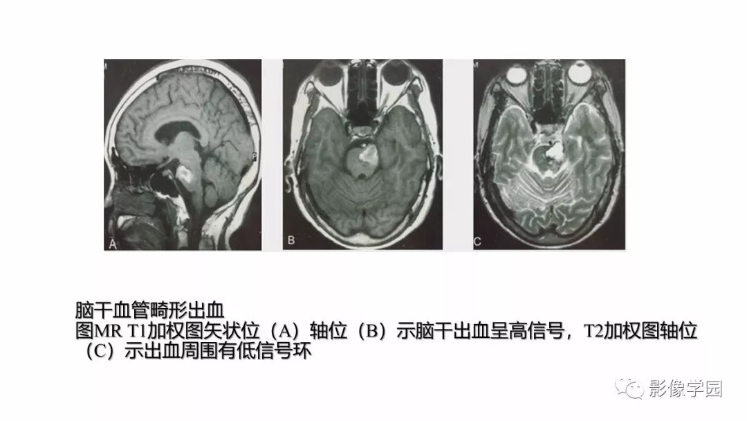 影像PPT - 【PPT】脑干病变的影像学表现-17