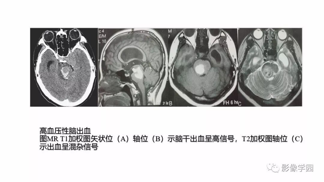 影像PPT - 【PPT】脑干病变的影像学表现-18
