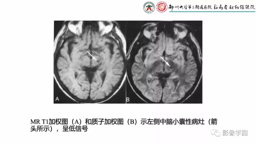 影像PPT - 【PPT】脑干病变的影像学表现-22
