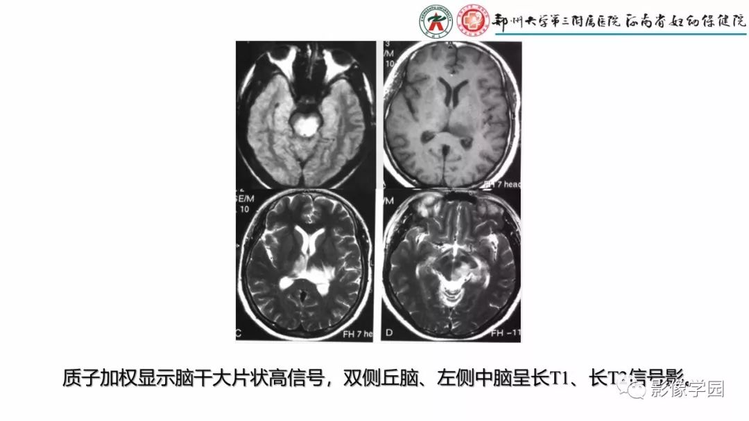 影像PPT - 【PPT】脑干病变的影像学表现-24