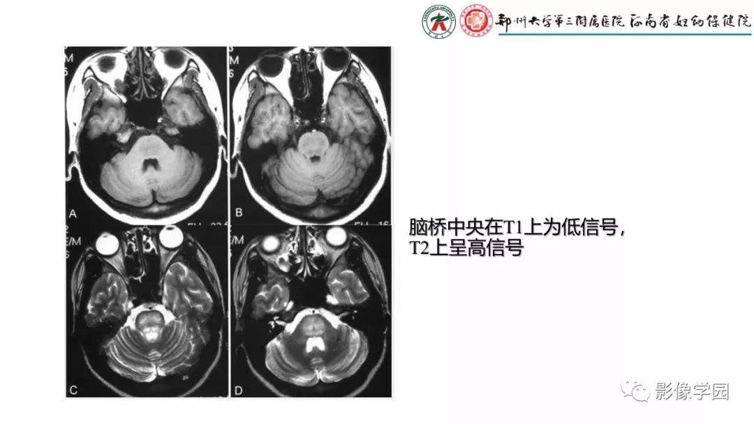 影像PPT - 【PPT】脑干病变的影像学表现-27