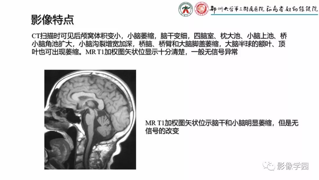 影像PPT - 【PPT】脑干病变的影像学表现-31