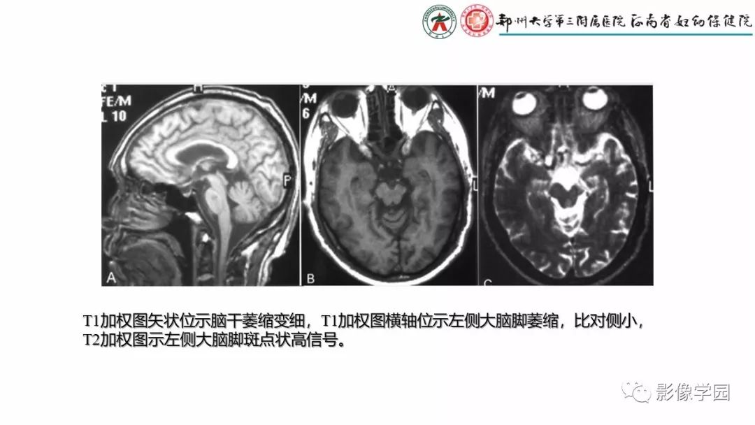 影像PPT - 【PPT】脑干病变的影像学表现-34