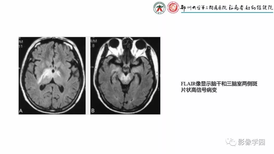影像PPT - 【PPT】脑干病变的影像学表现-38