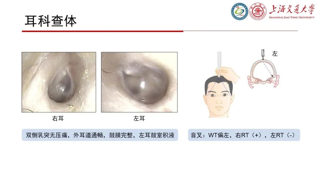 影像PPT - 【病例】脑脊液耳漏1例CT及MR病例讨论-3