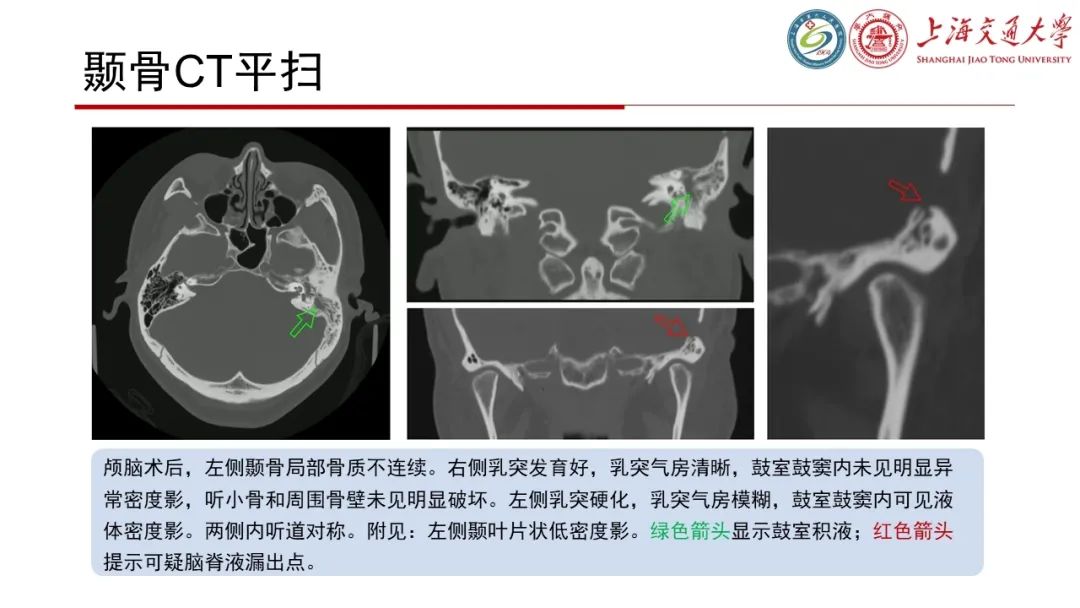 影像PPT - 【病例】脑脊液耳漏1例CT及MR病例讨论-6