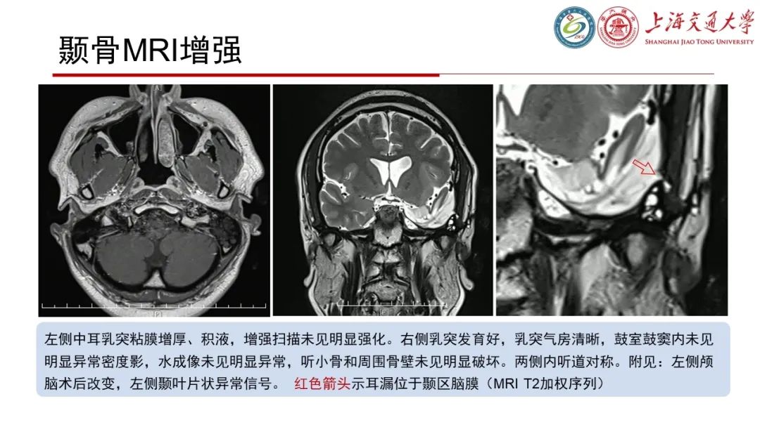 影像PPT - 【病例】脑脊液耳漏1例CT及MR病例讨论-7