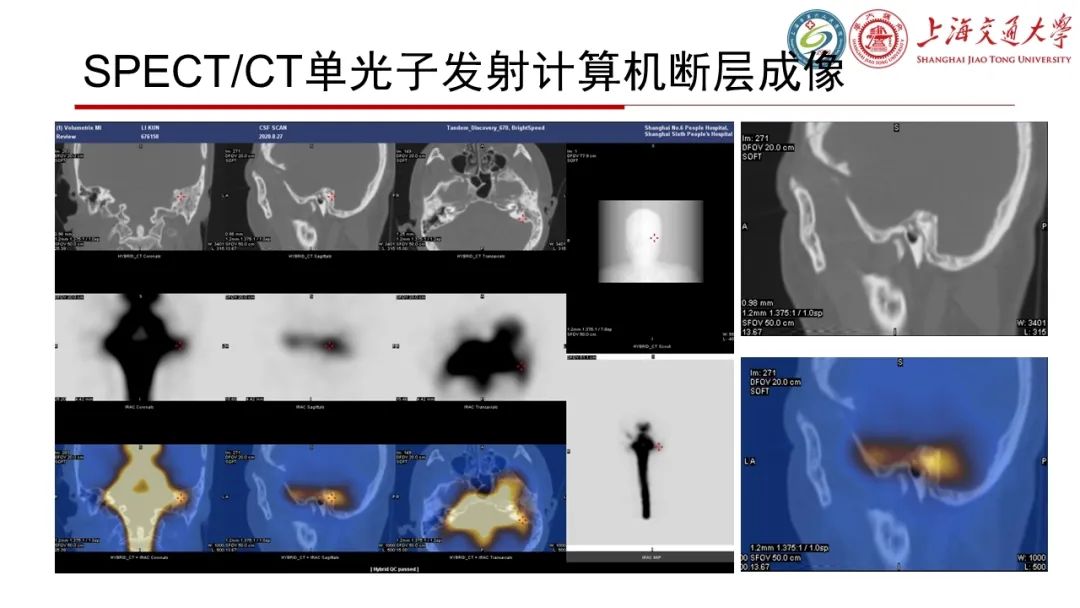 影像PPT - 【病例】脑脊液耳漏1例CT及MR病例讨论-8