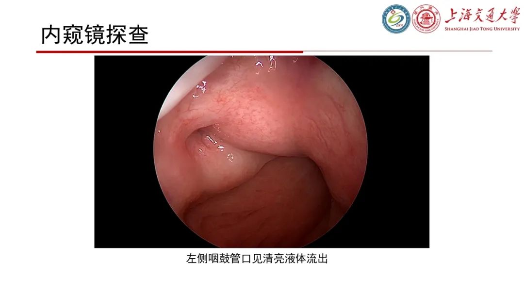 影像PPT - 【病例】脑脊液耳漏1例CT及MR病例讨论-9