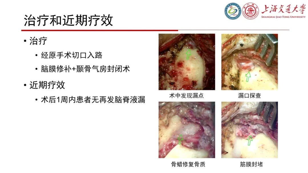 影像PPT - 【病例】脑脊液耳漏1例CT及MR病例讨论-12