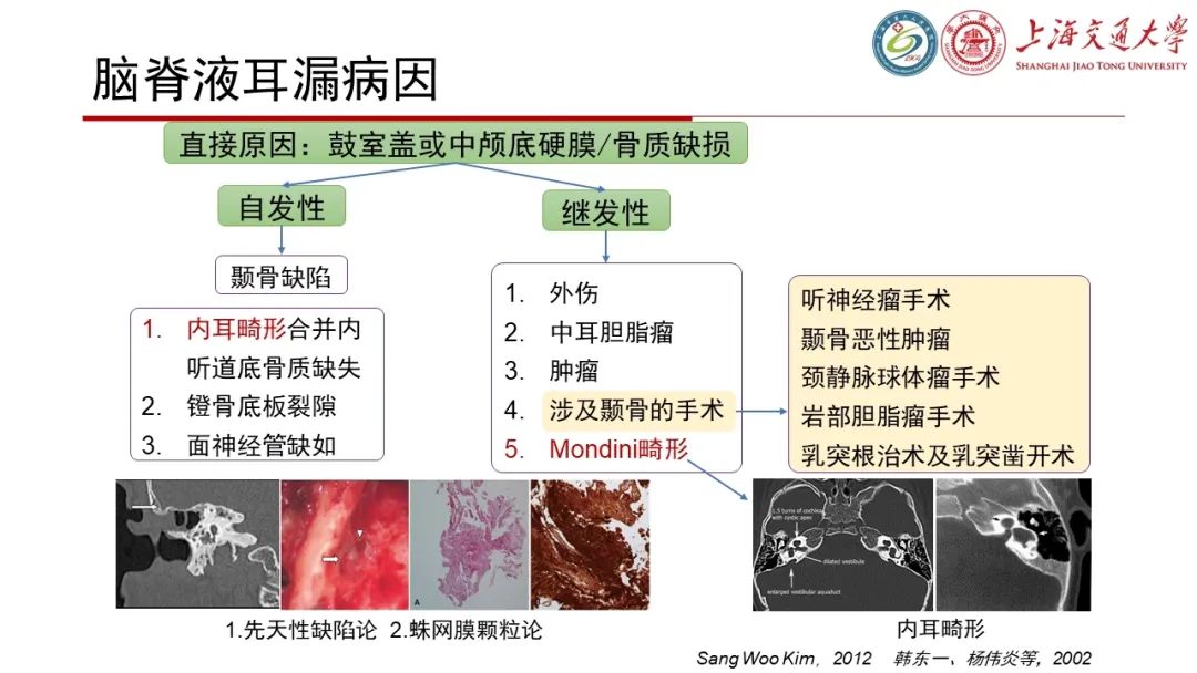 影像PPT - 【病例】脑脊液耳漏1例CT及MR病例讨论-15