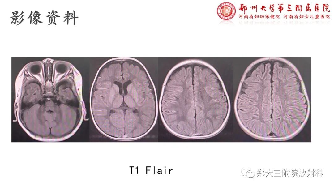 影像PPT - 【PPT】佩梅病的影像诊断-4