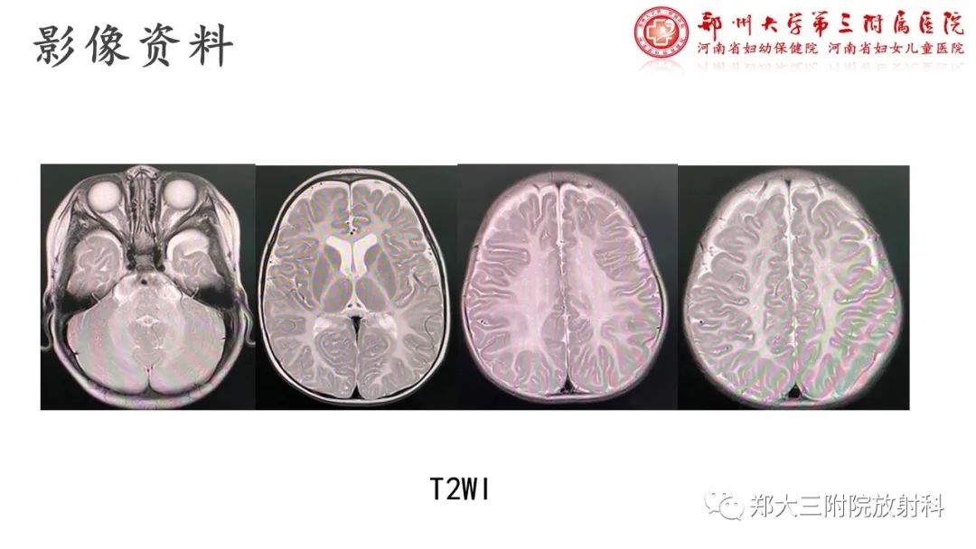 影像PPT - 【PPT】佩梅病的影像诊断-5