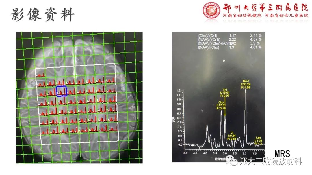 影像PPT - 【PPT】佩梅病的影像诊断-6
