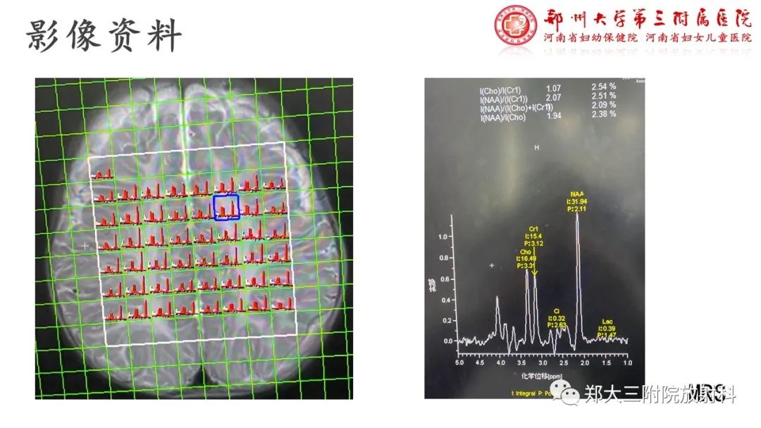 影像PPT - 【PPT】佩梅病的影像诊断-7