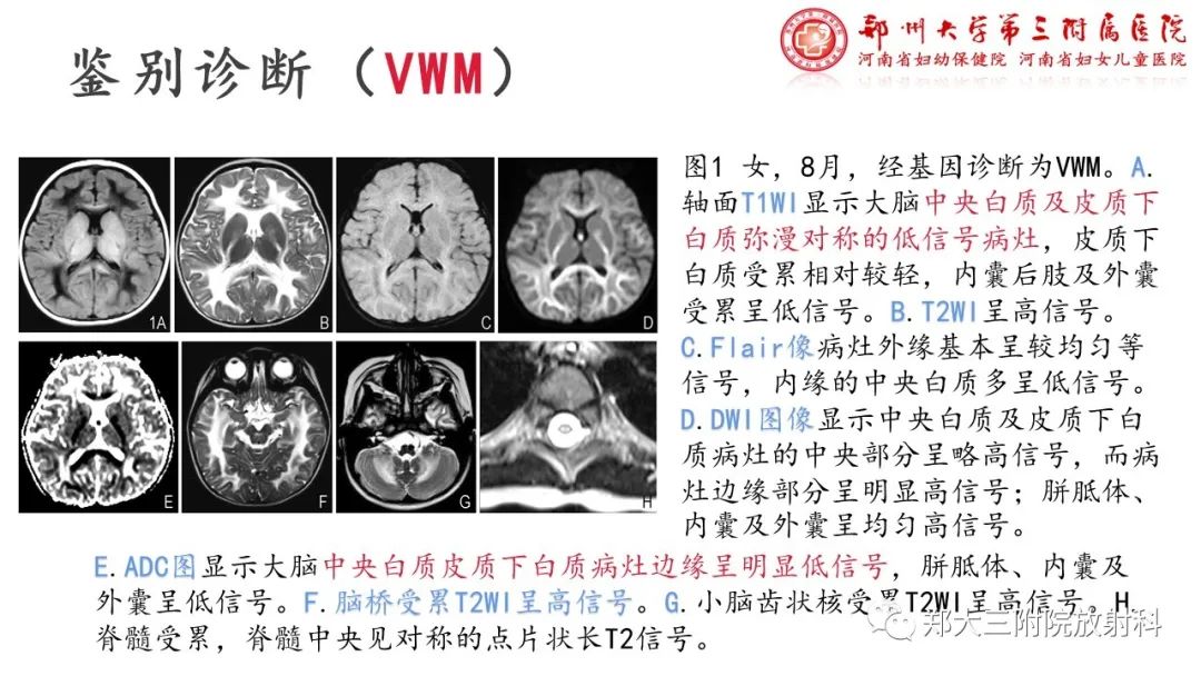 影像PPT - 【PPT】佩梅病的影像诊断-14