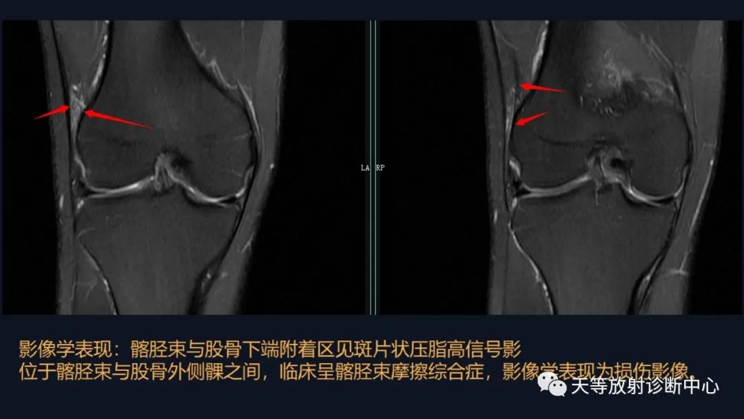 影像PPT - 【PPT】髂胫束摩擦综合症/髂胫束综合症-1