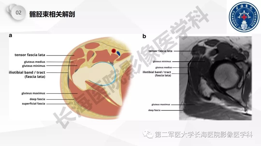 影像PPT - 【PPT】髂胫束摩擦综合症/髂胫束综合症-12
