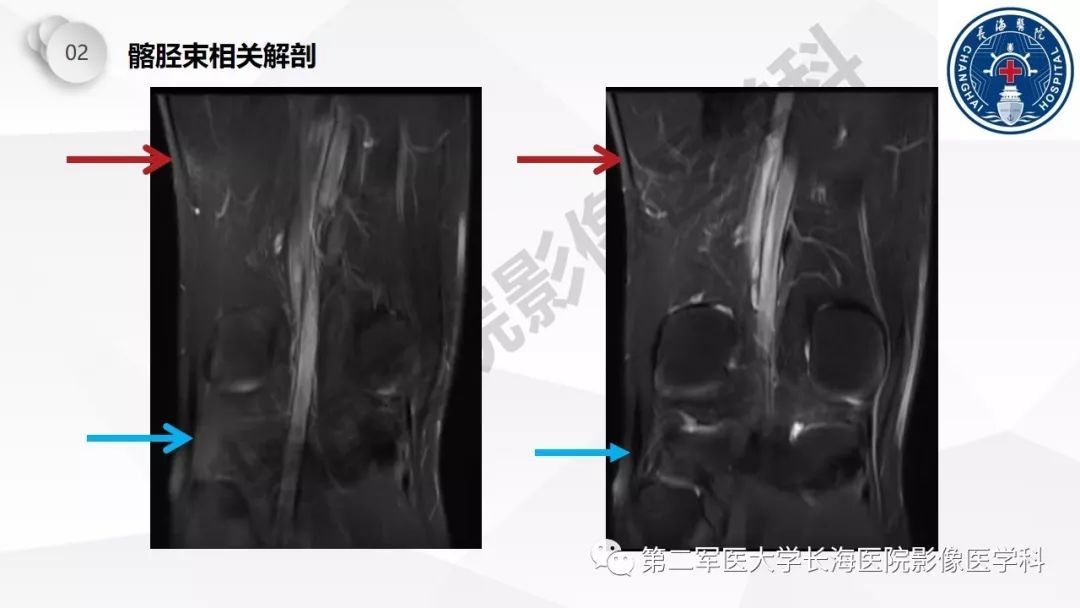 影像PPT - 【PPT】髂胫束摩擦综合症/髂胫束综合症-13