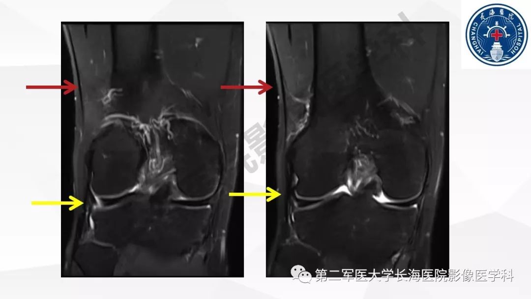 影像PPT - 【PPT】髂胫束摩擦综合症/髂胫束综合症-14