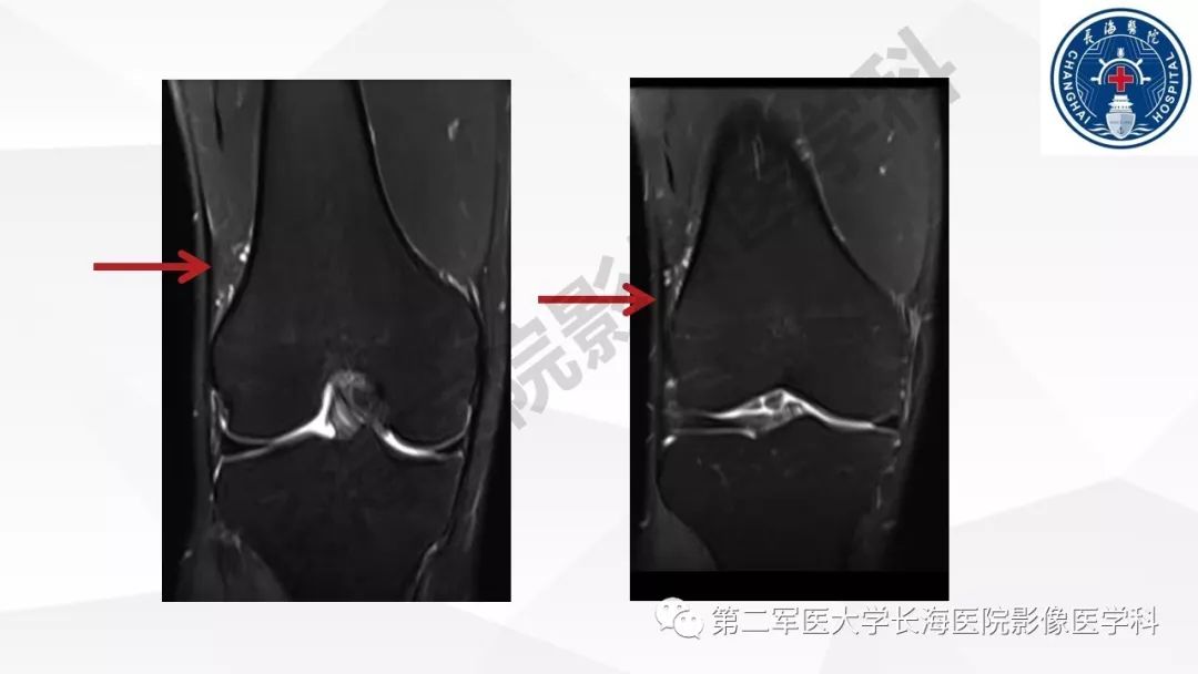 影像PPT - 【PPT】髂胫束摩擦综合症/髂胫束综合症-15
