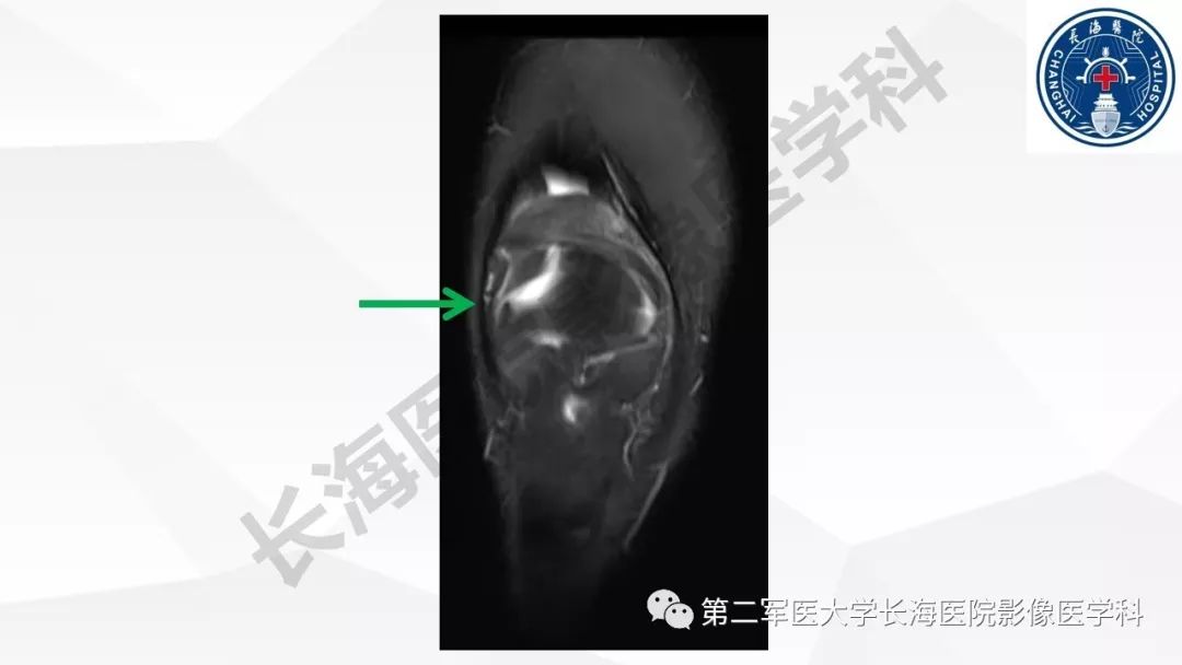 影像PPT - 【PPT】髂胫束摩擦综合症/髂胫束综合症-17