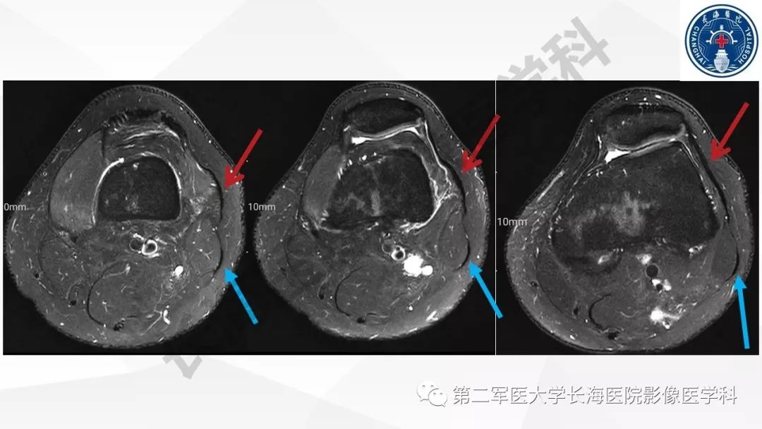 影像PPT - 【PPT】髂胫束摩擦综合症/髂胫束综合症-18