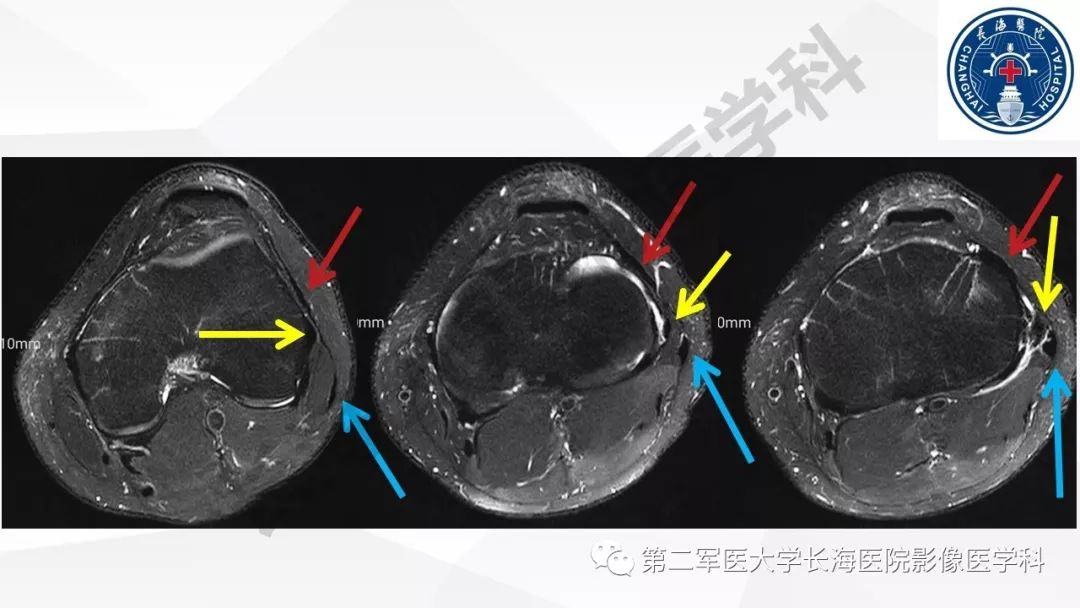 影像PPT - 【PPT】髂胫束摩擦综合症/髂胫束综合症-19