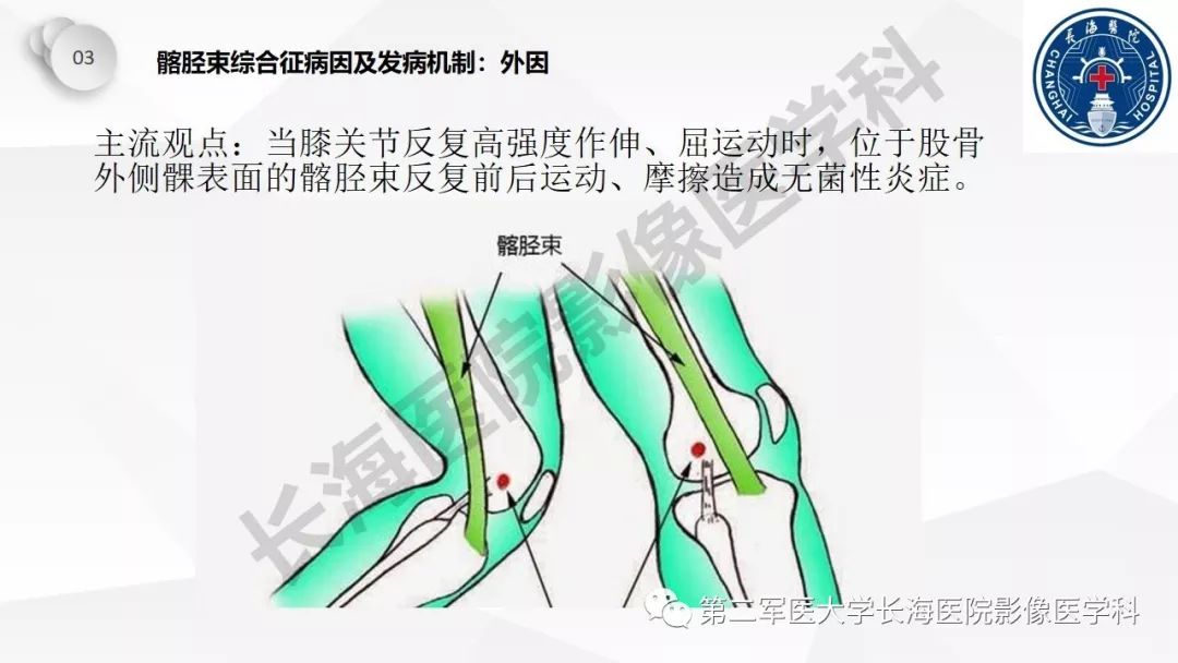 影像PPT - 【PPT】髂胫束摩擦综合症/髂胫束综合症-21